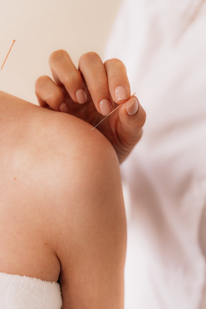 about-us Close-up of acupuncture needle therapy on a patient's shoulder illustrating alternative medicine.