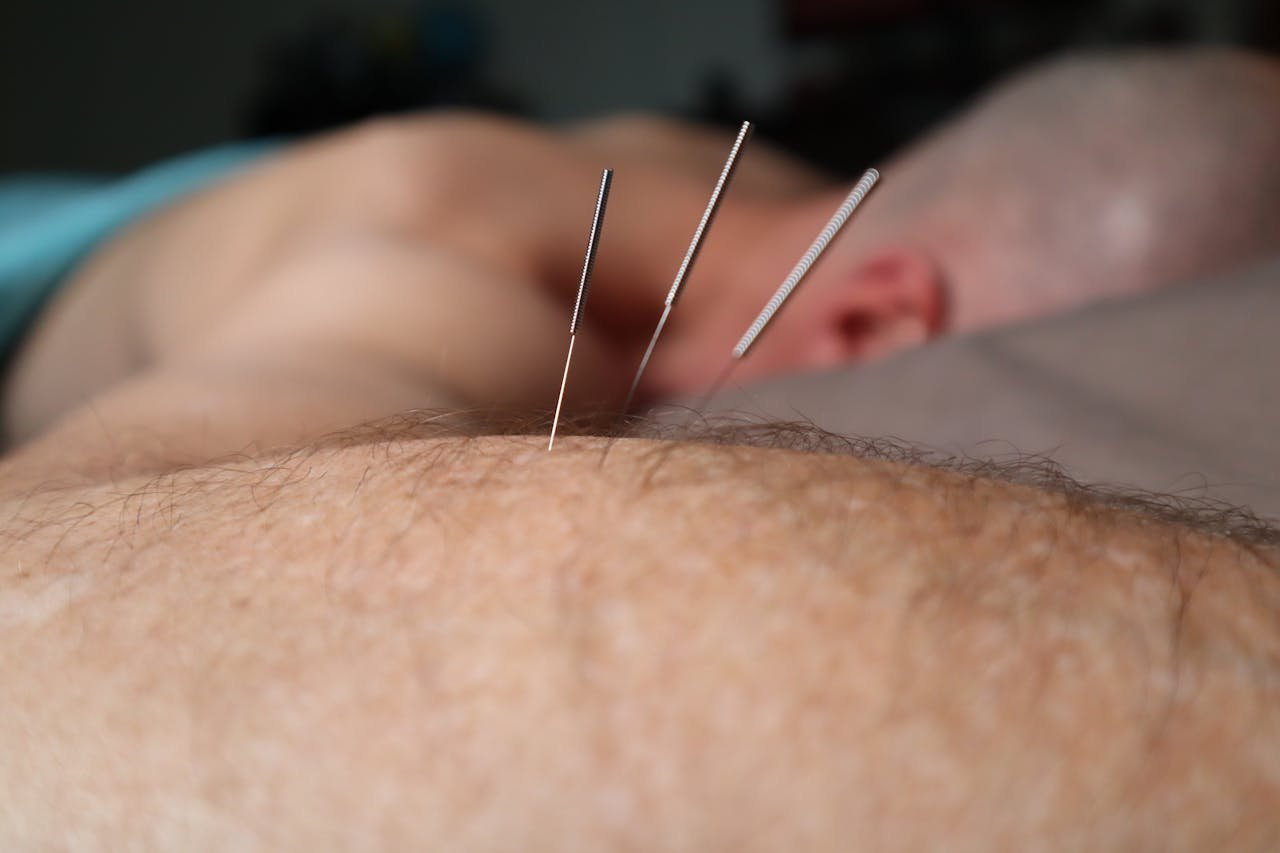 our-story Close-up of acupuncture needles during a therapy session, focusing on skin and relaxation.