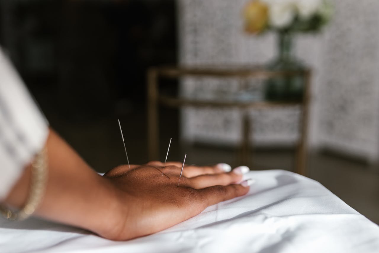 Close-up of acupuncture needles in a hand during treatment, promoting relaxation.